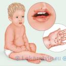 Вирус Коксаки — основные симптомы, методы лечения у детей и взрослых, фото проявления заболевания у ребенка, профилактика