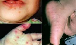 Вирус Коксаки: симптомы и лечение у детей (фото), вирус у взрослых