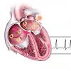 Препарат при острой сердечной недостаточности и инсульте Правила определения острой сердечной недостаточности и инсульта